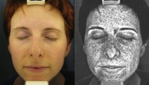 picture of sun damage via uv photography